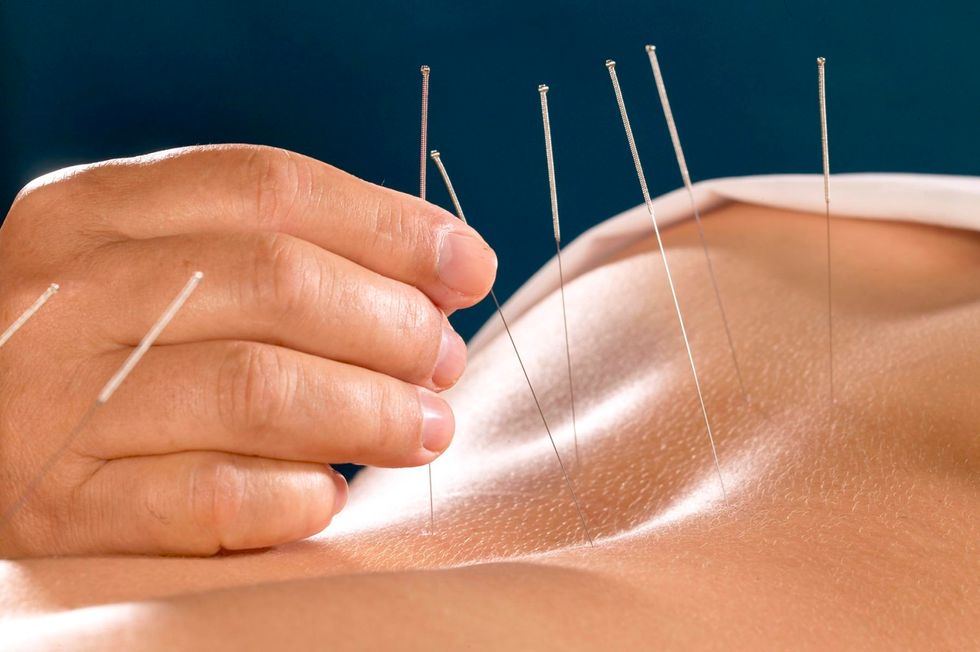 Acupuncture Therapy